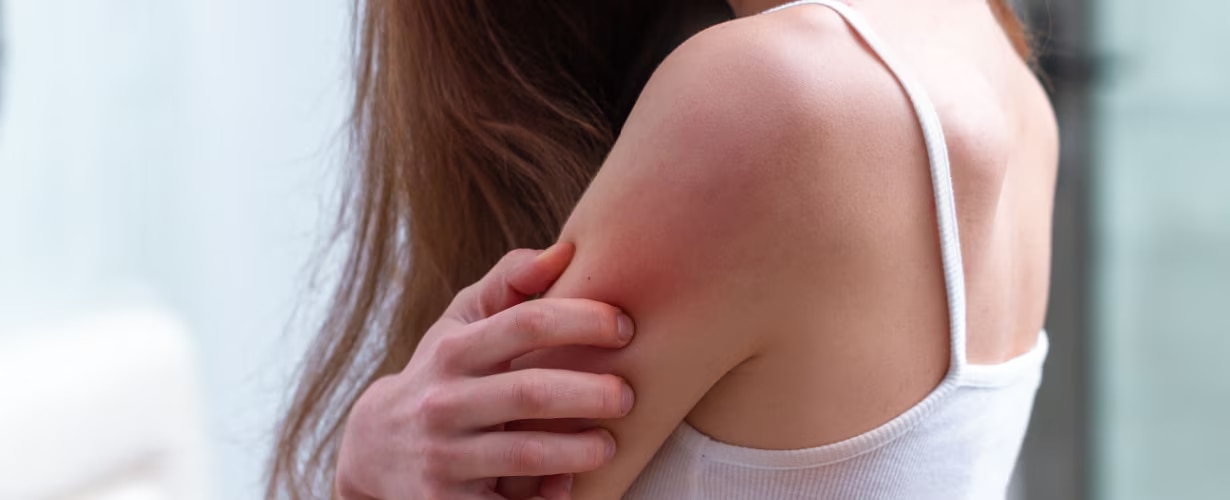 &iquest;Qu&eacute; es la dermatitis at&oacute;pica?