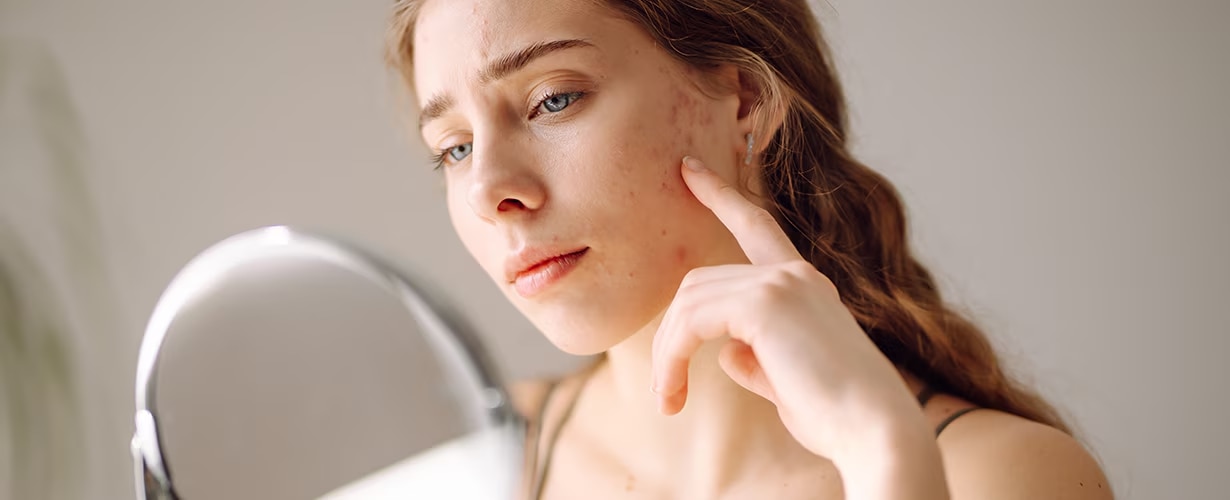 Tipos de acn&eacute; y c&oacute;mo tratarlos