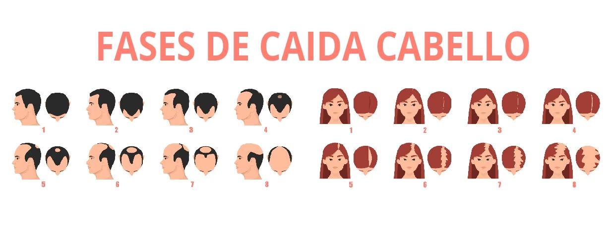 Fases de caída el cabello en hombres y mujeres.
