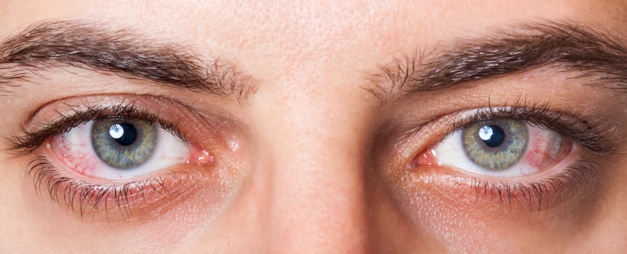 &iquest;Conjuntivitis?, identifica sus s&iacute;ntomas, tipos y c&oacute;mo evitarla