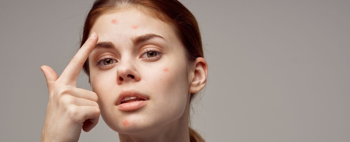 &iexcl;Dile adi&oacute;s al acn&eacute;! Sigue estos 7 pasos para evitarlo