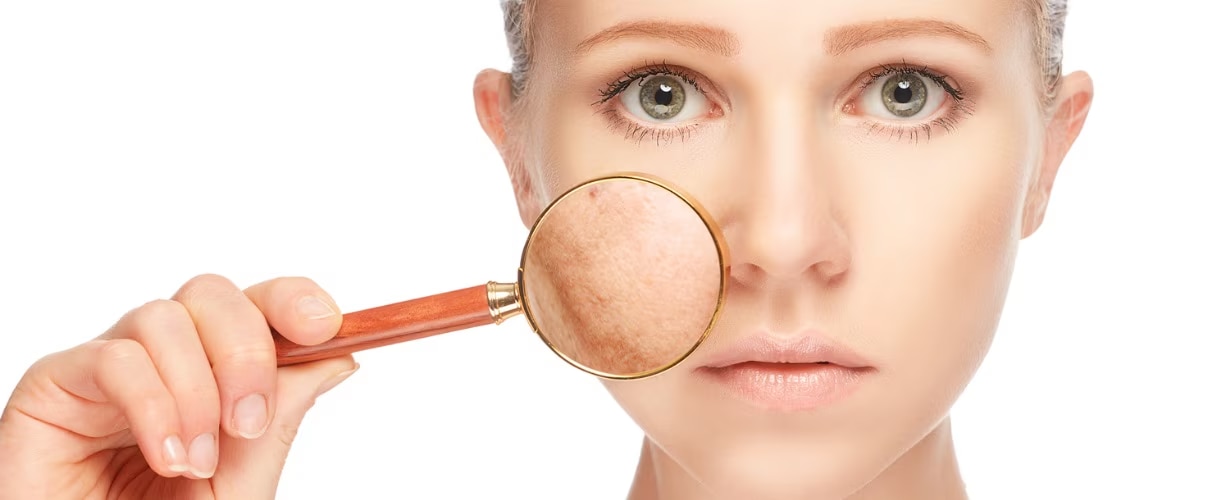 &iquest;Manchas faciales? 5 tipos y 6 tips para prevenirlas